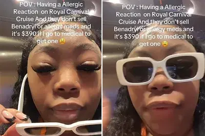Woman having an allergic reaction
