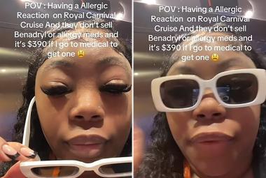 Woman having an allergic reaction